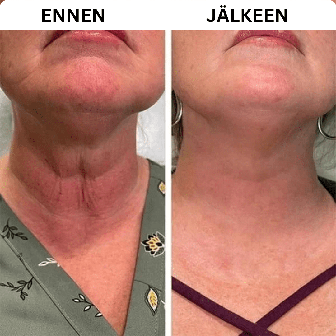 Martalvo ™ | Botox kasvoseerumi
