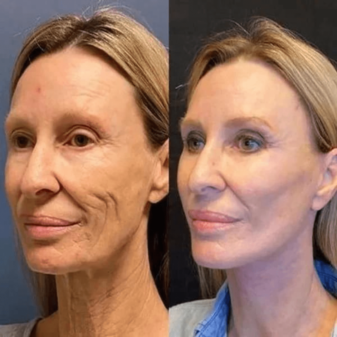 Martalvo ™ | Botox kasvoseerumi